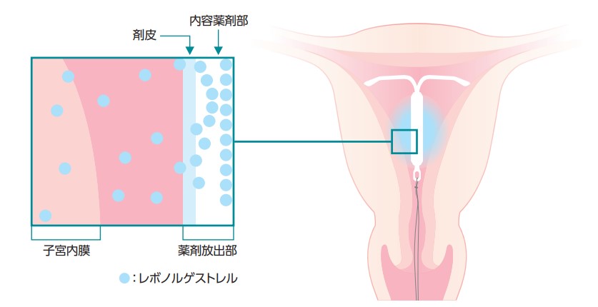 ミレーナ 副作用 臭い